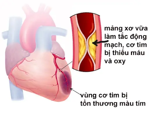 Thiếu máu cơ tim làm tế bào cơ tim bị hoại tử và dẫn đến nhồi máu cơ tim.webp
